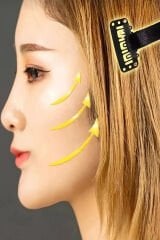 Siyah Yüz Germe Tokası Botox Tokası